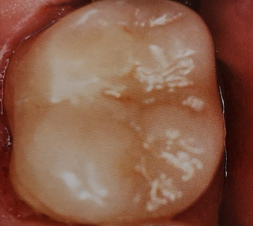 Primo piano di un molare giallastro in bocca, che mostra la consistenza naturale e lievi imperfezioni.