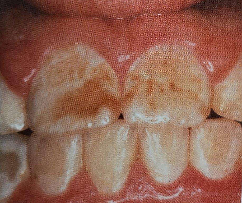 Primo piano di denti con scolorimento marrone e macchie bianche, probabilmente fluorosi dentale.