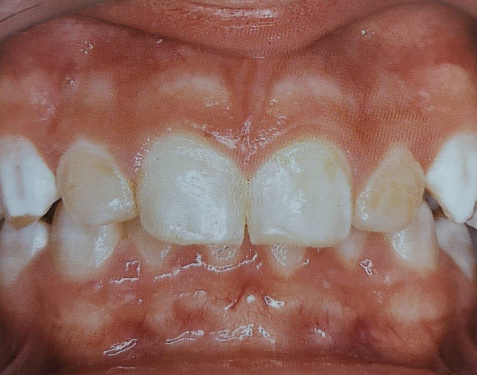 Primo piano dei denti di un bambino. I denti anteriori sono scoloriti e presentano alcune macchie bianche.