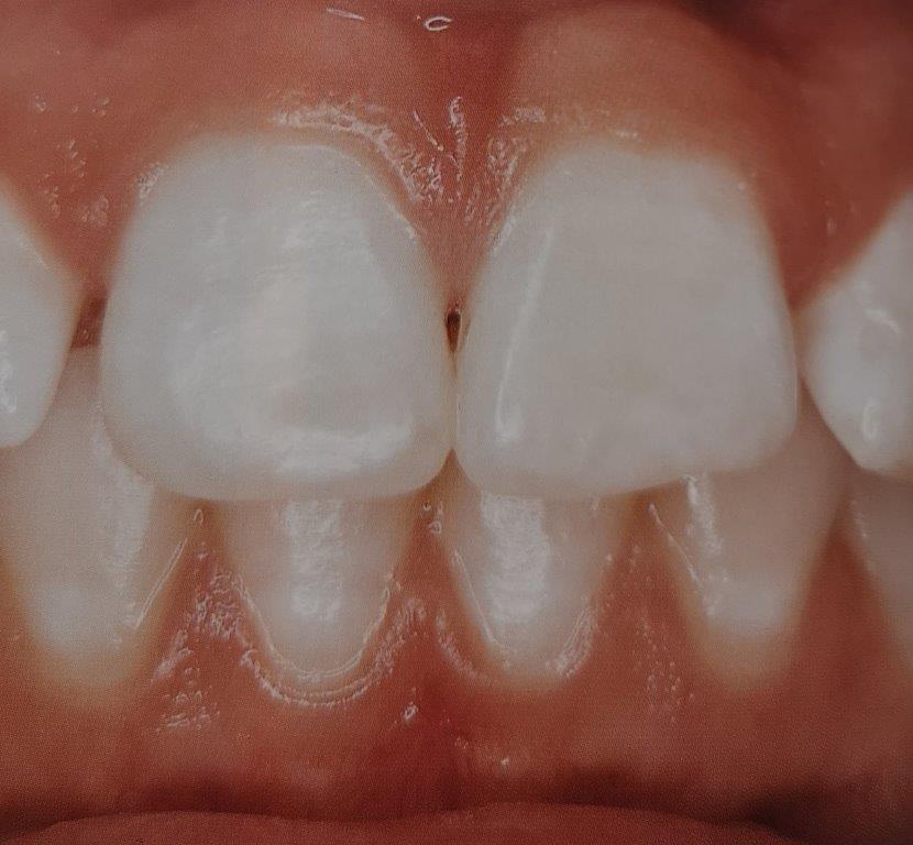 Primo piano dei denti anteriori. Bianco brillante, sani, leggermente traslucidi con margine gengivale visibile.