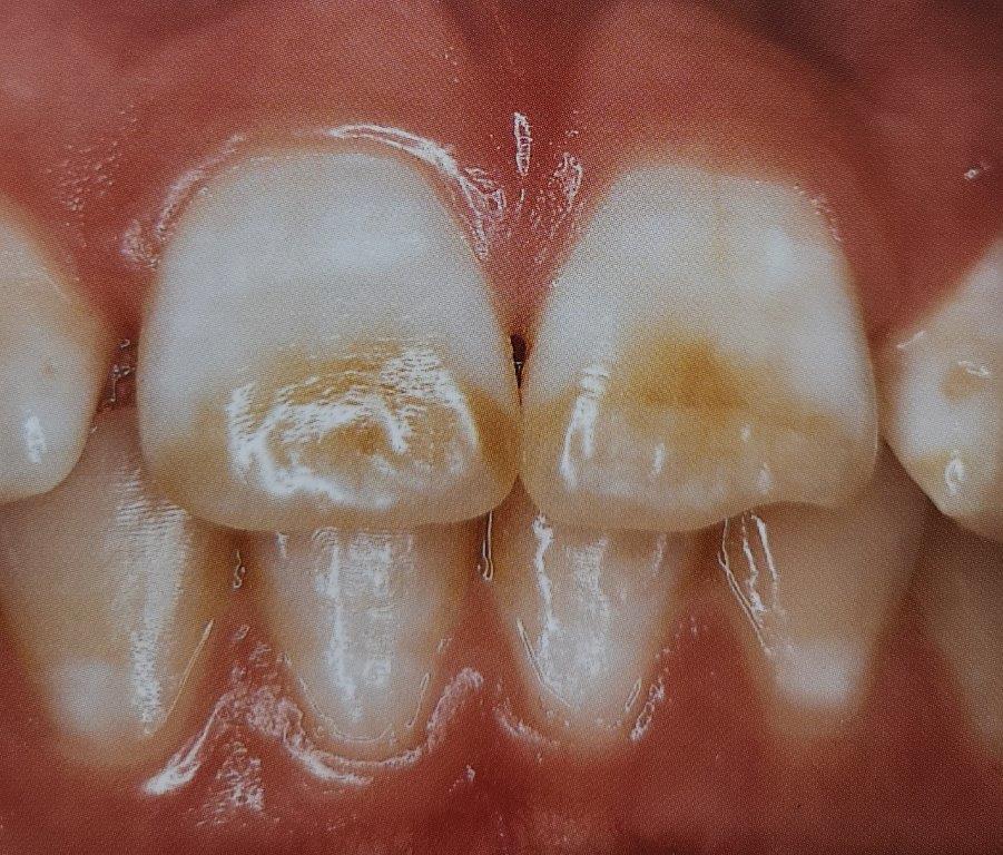 Primo piano dei denti di un bambino che mostra macchie bianche e una colorazione brunastra sui due denti anteriori.