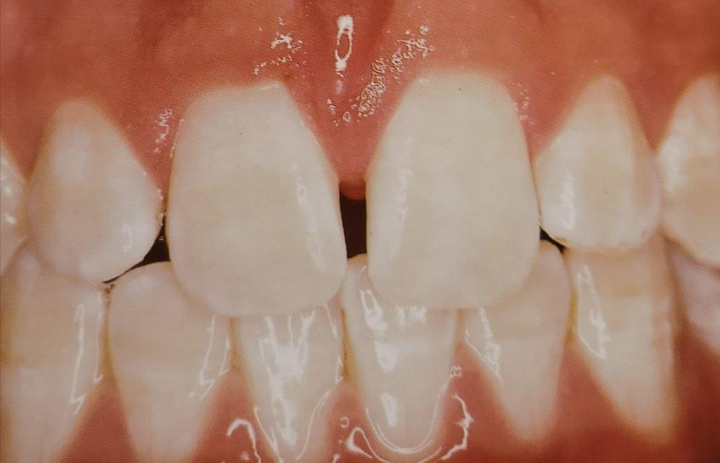 Primo piano di denti umani con uno spazio tra i due denti anteriori, che mostra una bocca sana.