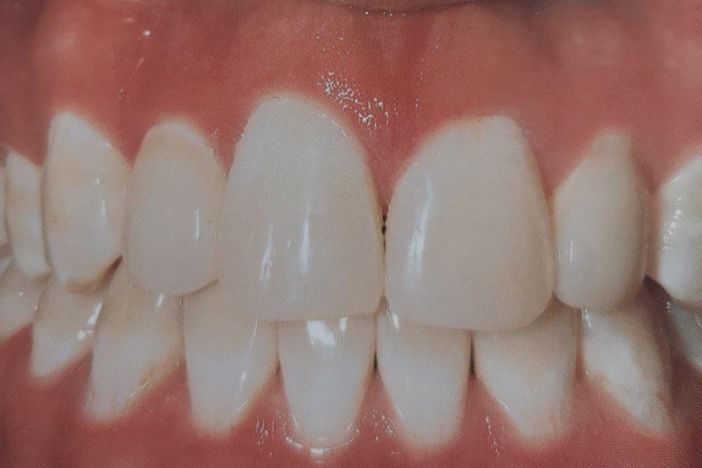 Primo piano di denti bianchi e dritti in una bocca aperta, in contrasto con le gengive rosa.