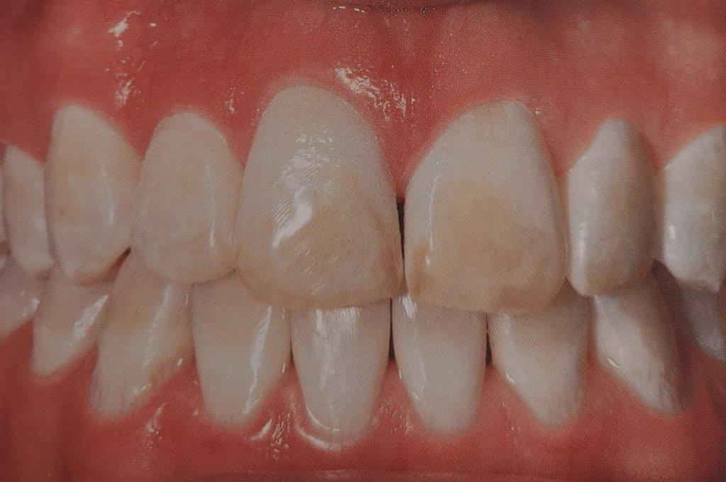 Primo piano dei denti con scolorimento; i denti anteriori sono più scuri degli altri.