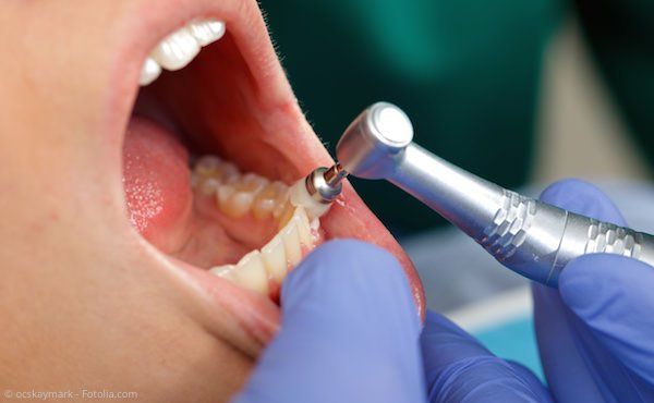 Veneers (Verblendschalen)