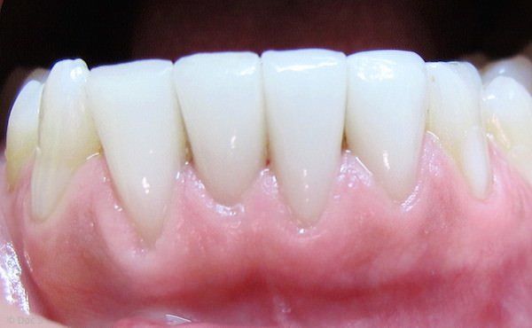 Veneers auf unteren Schneidzähnen