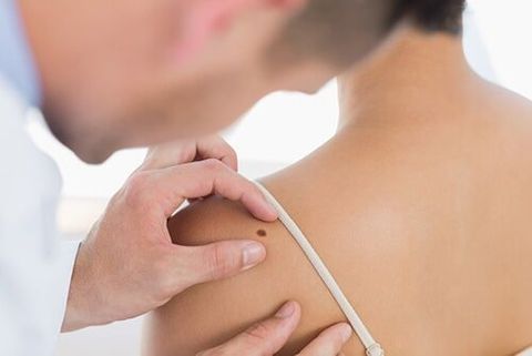 Doctor Examining Mole on Back of Woman - Skin Conditions in Bountiful, UT