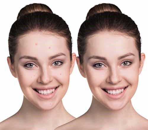 Face of a Lady Before and After Facial Treatment - Skin Conditions in Bountiful, UT Face of a Lady Before and After Facial Treatment - Skin Conditions in Bountiful, UT