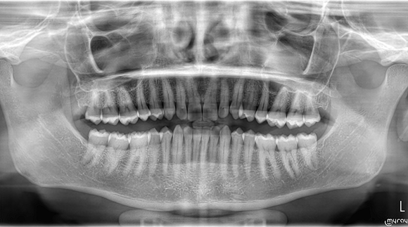 raggi x denti