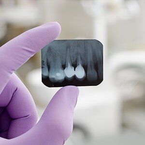 Root Canal X-ray — Family Dentistry in Castleton, NY Root Canal X-ray — Family Dentistry in Castleton, NY