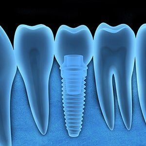 Dental implant x-ray — Family Dentistry in Castleton, NY Dental implant x-ray — Family Dentistry in Castleton, NY