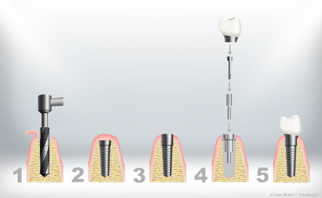 Die meisten Implantate werden im sog. zweiphasigen Verfahren eingesetzt. Die meisten Implantate werden im sog. zweiphasigen Verfahren eingesetzt.