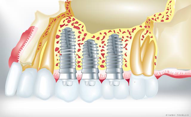 Implantate zum Ersatz fehlender Zähne Implantate zum Ersatz fehlender Zähne