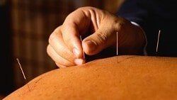 Acupuncture, Rehabilitation Services in Fort Lee, NJ Acupuncture, Rehabilitation Services in Fort Lee, NJ