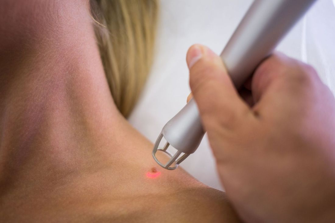 Trattamento laser
