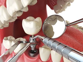 DENTAL IMPLANTS dental implants - Glenville Smiles -Schenectady, NY