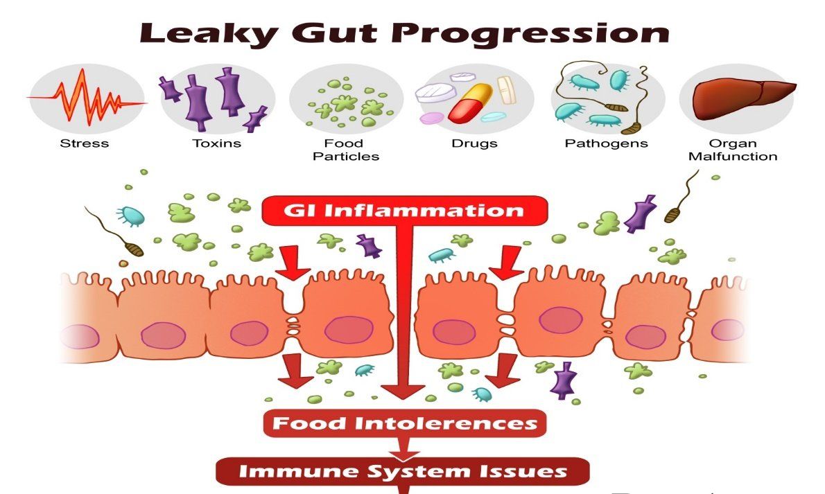 leaky gut stress autoimmune sibo