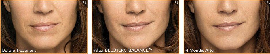 Before After Belotero Treatment - NewSkin Laser Center