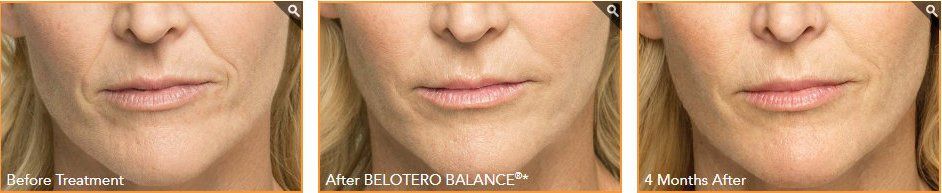 Before After Belotero Treatment - NewSkin Laser Center