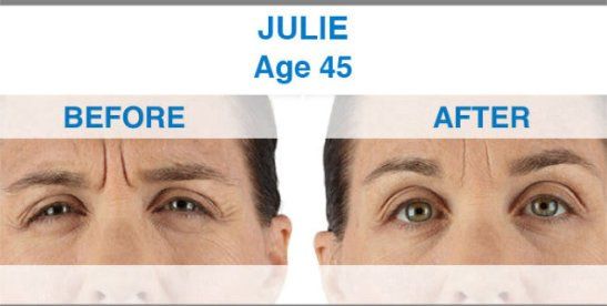 Before After Xeomin Treatment  - NewSkin Laser Center