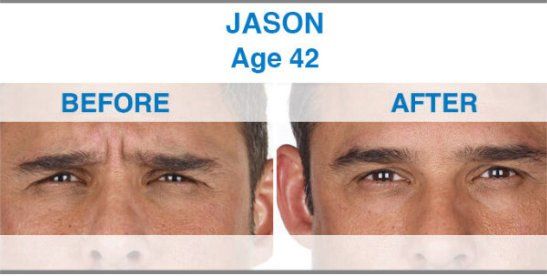 Before After Xeomin Treatment  - NewSkin Laser Center