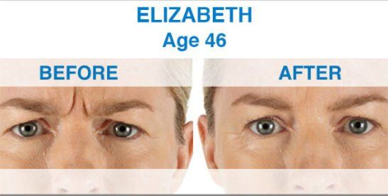 Before After Xeomin Treatment  - NewSkin Laser Center