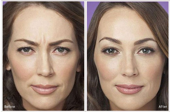 $50 Off Botox Rebate Special