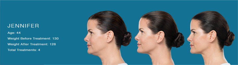Before After Kybella Treatment - NewSkin Laser Center 
