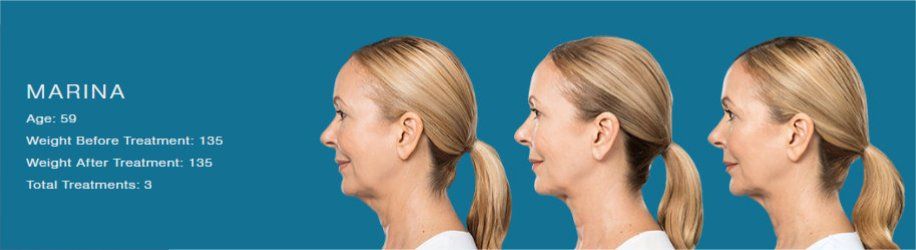 Before After Kybella Treatment - NewSkin Laser Center 