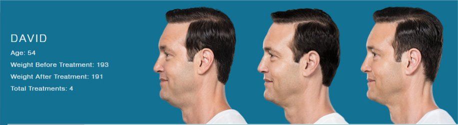 Before After Kybella Treatment - NewSkin Laser Center 