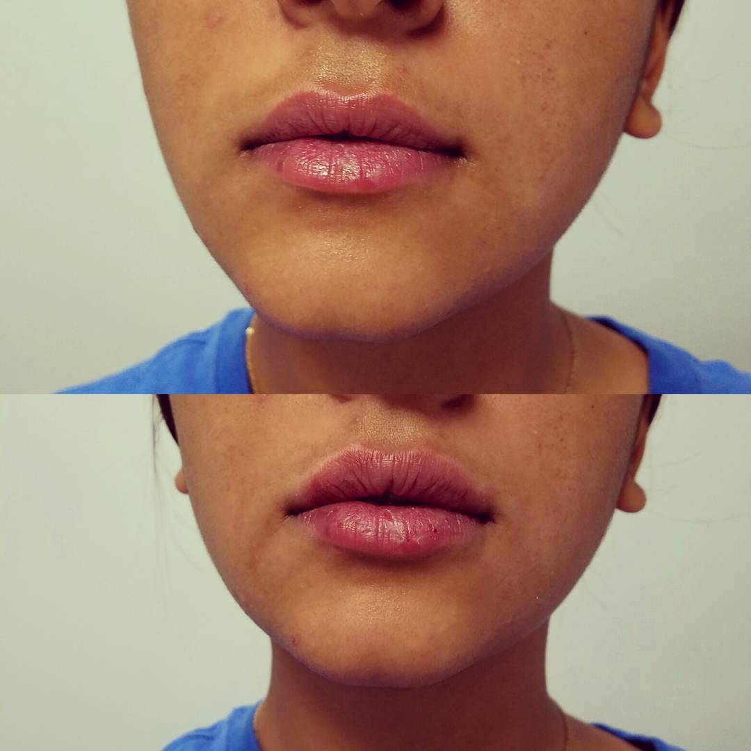 Restylane Lip Filler Lip Filler - Simi Valley | Thousand Oaks | Westlake Village