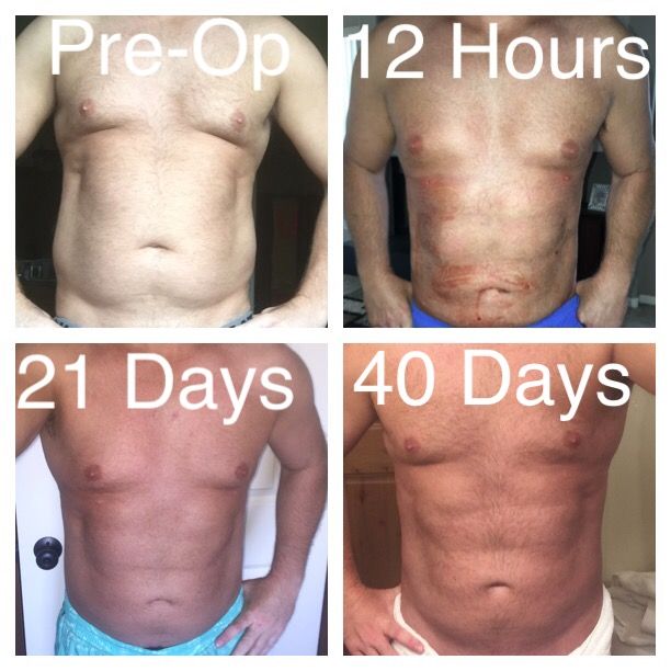 abdominal etching and sculpting