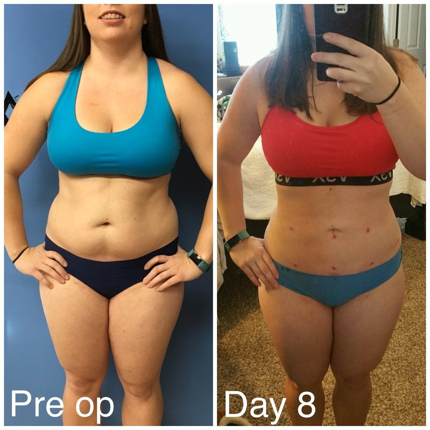 liposuction abdomen and love handles
