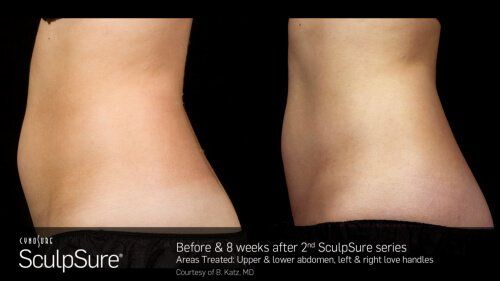 sculpsure - fat dissolving Sculpsure - fat dissolving