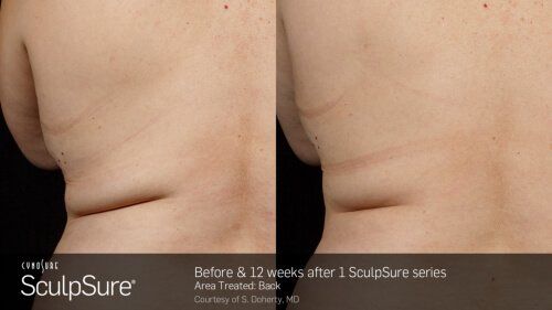 Before After SculpSure Treatment - NewSkin Laser Center