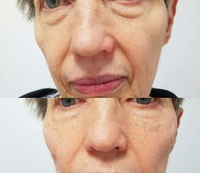 tear trough filler tear trough filler injection