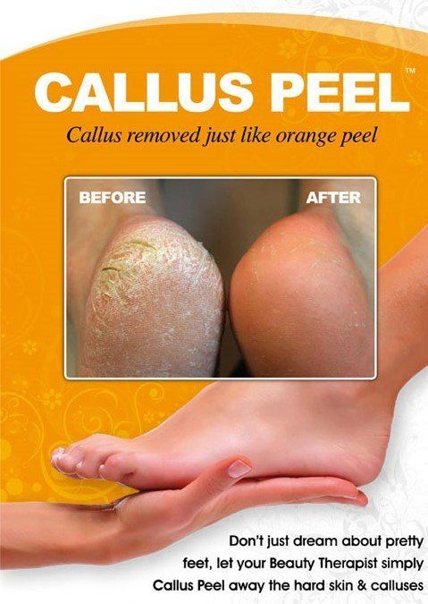 Callus peel