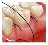 gum surgery