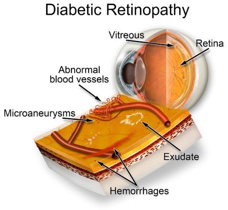 Diabetic Retinopathy