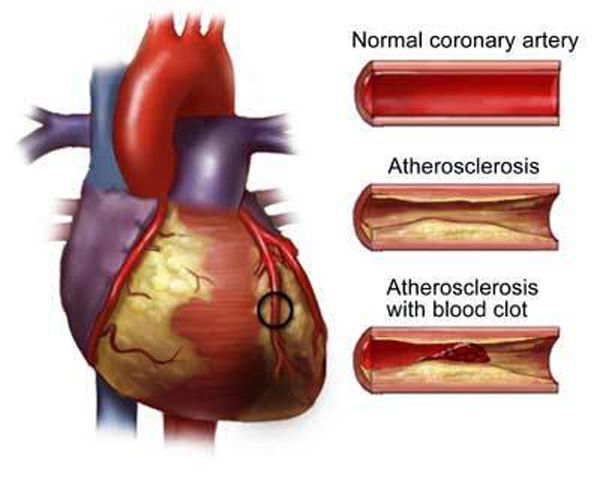 Coronary Artery