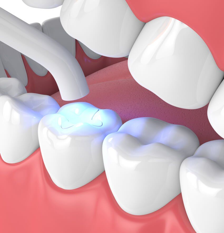 Tooth Colored Fillings