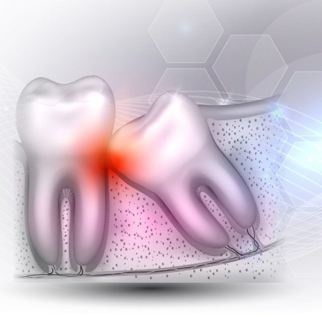 Wisdom Tooth Extractions 