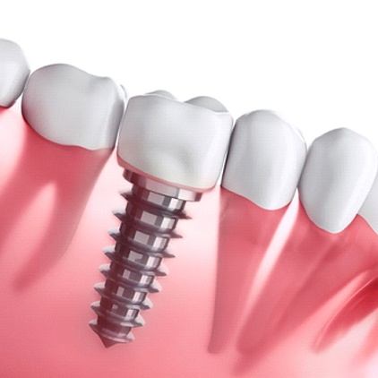 Dental Implants