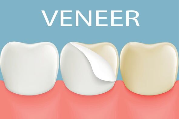Teeth Whitening — teeth whitening in Schererville, IN Teeth Whitening — teeth whitening in Schererville, IN