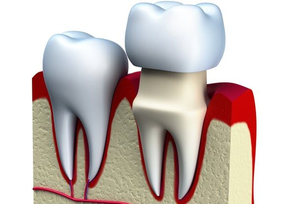 Dental Crowns - Saint John, IN - Indiana Implants & Dentistry Dental Crowns - Saint John, IN - Indiana Implants & Dentistry