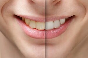 Man Smile Before and After Teeth Whitening - Teeth Whitening in Schererville, IN