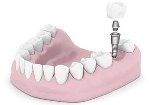 Teeth Implant — implants in Schererville, IN Teeth Implant — implants in Schererville, IN