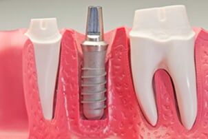Dental Implant Model - Restorative Dentistry in Schererville, IN Dental Implant Model - Restorative Dentistry in Schererville, IN