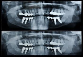 Pan_x_ray — panorex in Schererville, IN Pan_x_ray — panorex in Schererville, IN