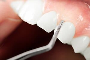 Gums - General Dentistry in Schererville, IN